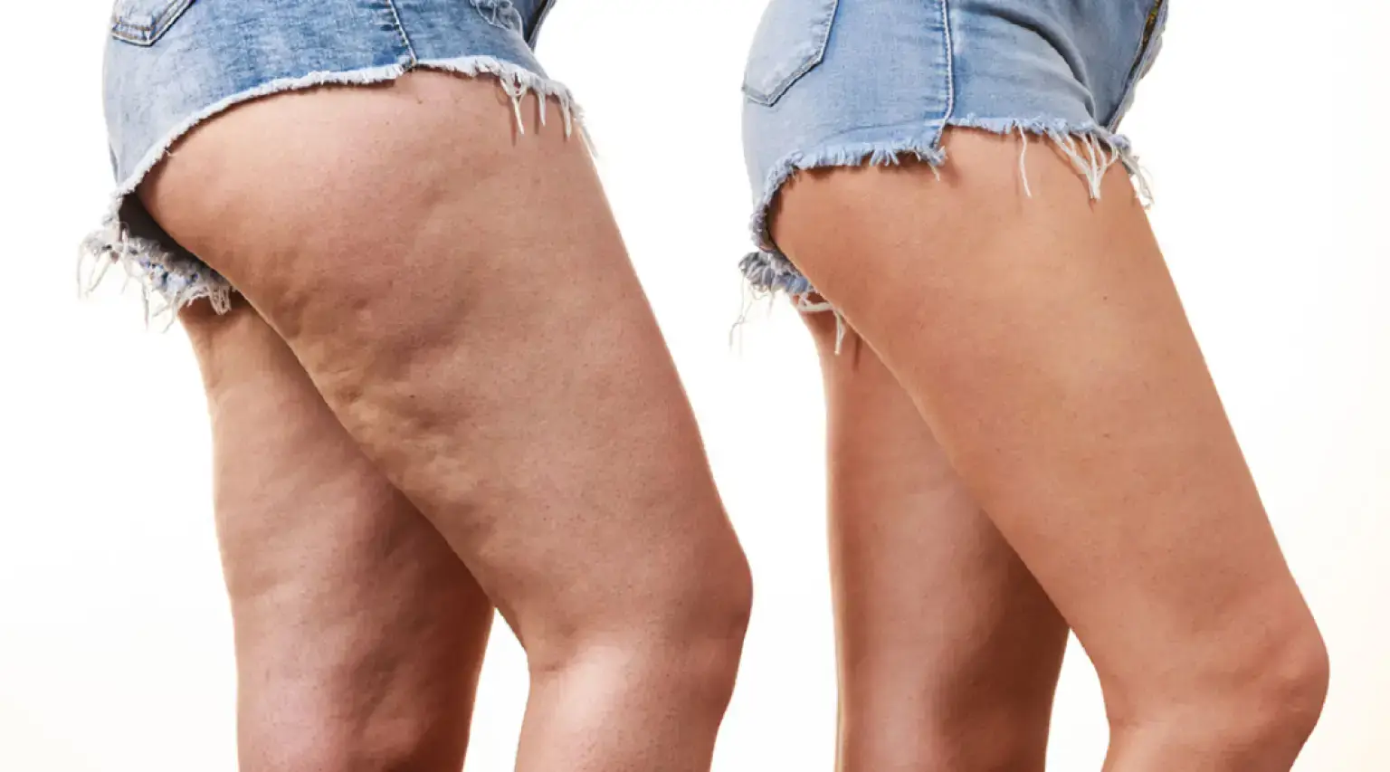 Corso Trattamento del Lipedema per Fisioterapisti Corso Trattamento del Lipedema per Fisioterapisti